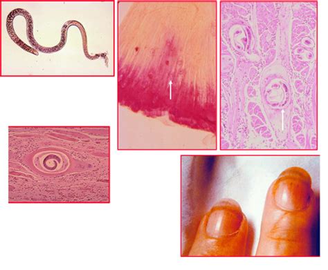 Trichinosis (Pork Parasite) Pathophysiology, Signs, 57% OFF