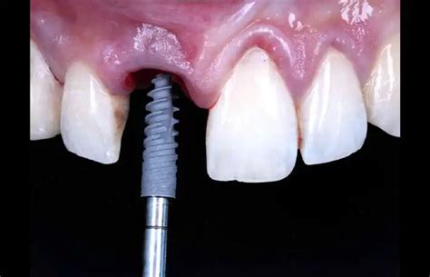 loading implantology  albania dr roland zhuka