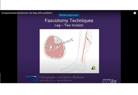 Compartment Syndrome — OrthopaedicPrinciples.com