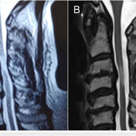 Pre And Postoperative Cervical MRI Sagittal MRI T2 Weighted A