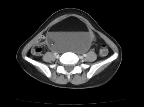 Mature Cystic Ovarian Teratoma Radiology Reference Article