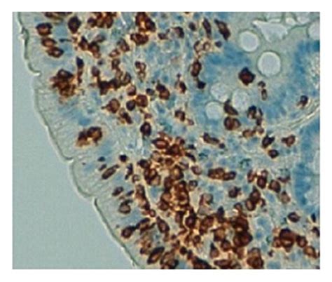 Duodenal Histopathological Features A B C Partial Villous Atrophy