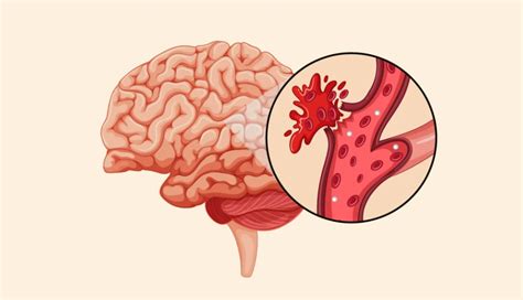 What is a Hemorrhagic Stroke? — Bergin Motion