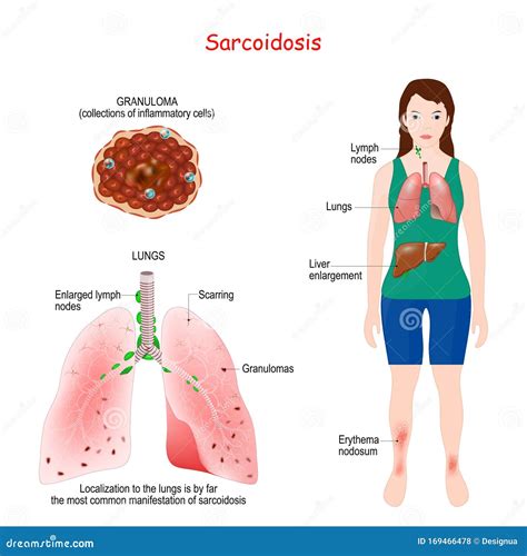 Sarcoidosis Signs and Symptoms. Development of Granulomas Stock Vector