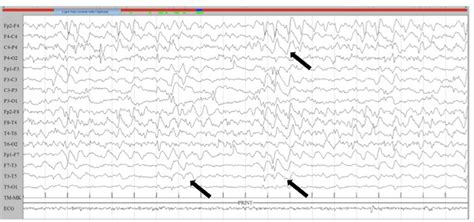 Electroencephalogram Notes Lateralized Periodic Discharges With