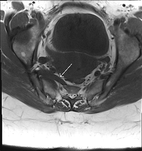 Piriformis Syndrome Mri