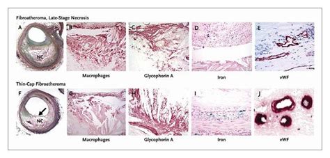 Intraplaque Hemorrhage And Progression Of Coronary Atheroma Nejm