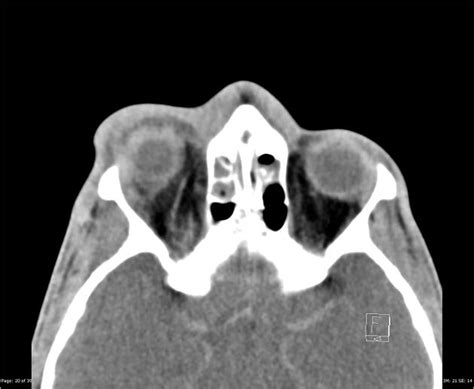 preseptal cellulitis  orbital cellulitis