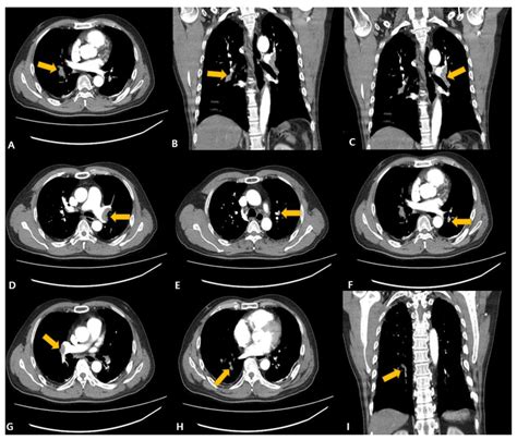 Chest Aortic Dissection Angio Mdct Multi Detector Computed