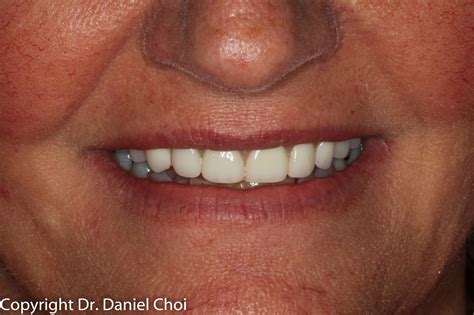 Snap In Dentures North Texas Dental Surgery