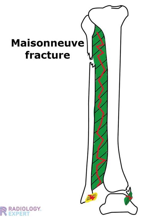 Maisonneuve Fracture