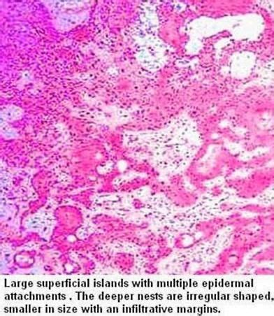 Pathology Of Eccrine Porocarcinoma Dr Sampurna Roy MD Sweat Gland