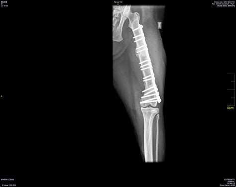 What surgeons do to repair serious bone fractures – Artofit
