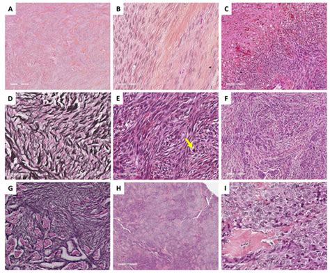 Relevance Of Molecular Pathology For The Diagnosis Of Sex CordStromal Tumors Of The Ovary A