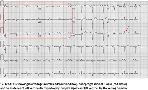 The Amazing Cardiac Amyloidosis Ekg And Echocardiogram International