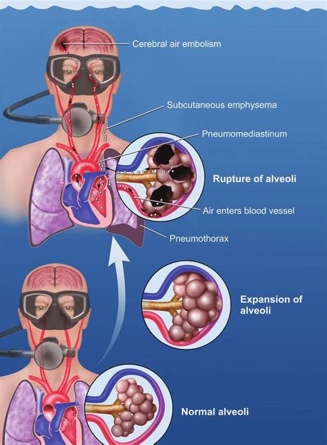 Diving After Pulmonary Embolism at Eloise Rameriz blog