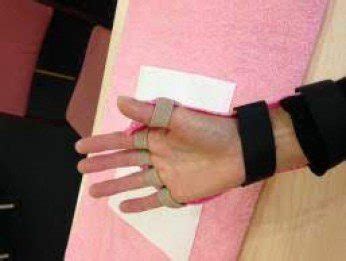 Radial Nerve Palsy Splinting Merivale Hand Clinic