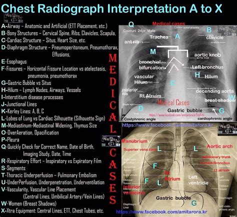 Chest rx interpretation | Radiology student, Radiology, Medical imaging