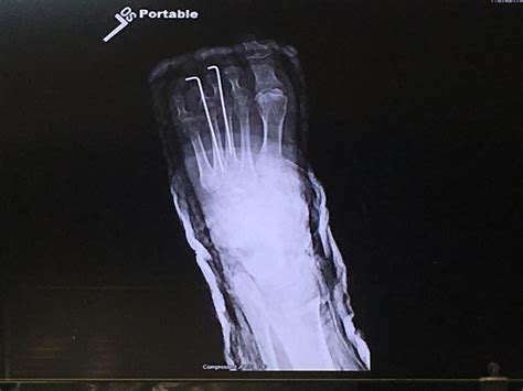 My foot after 5 breaks & 2 pins. : r/Radiology