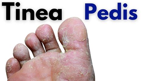 Tinea Pedis Symptoms And Treatment Toe Fungus Infection Athletes Foot Youtube