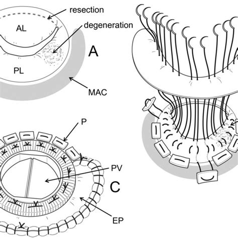 degeneration  posterior medial scallop  annular calcification