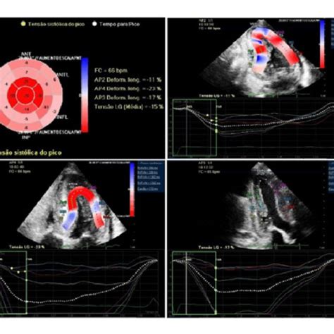 Ecocardiografia Speckle Tracking de paciente amiloidose Vídeos e