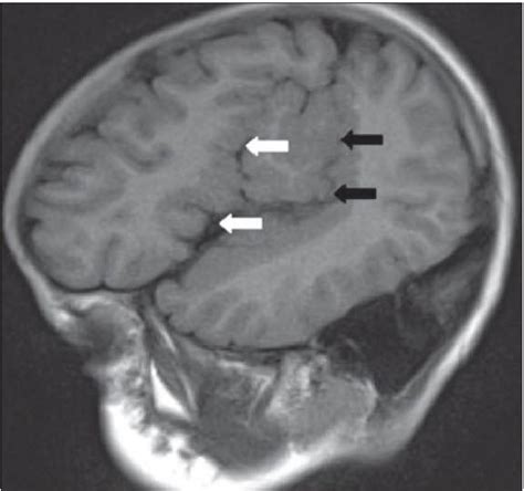 Congenital Bilateral Perisylvian Syndrome A Rare Cause Of Epilepsy