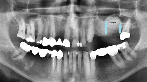 after-sinus-lift - Dental Implants PA, Gum Disease PA, Implant dentist ...