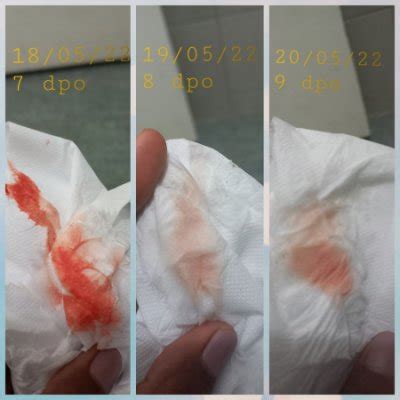 Quando Acontece O Sangramento De Nidação - Sangramento De Nidação: Fotos | Sangramento de nidação: o que é e por ...