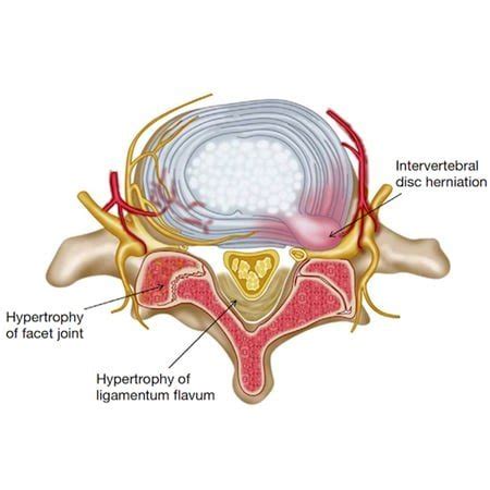 Ligamentum Flavum Hypertrophy | Definition, Cause And Treatment