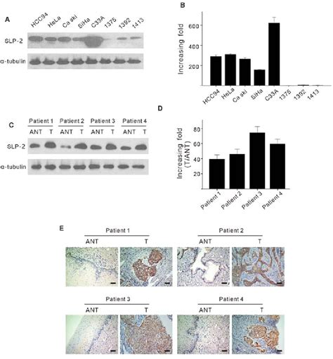 Figure From Stomatin Like Protein Is Overexpressed In Cervical