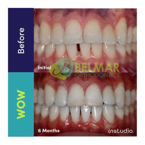 Before and After Pictures of Dental Braces | Belmar Orthodontics in ...