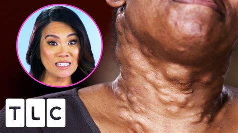 Dr Lee Pops Over 20 Cysts On This Woman S Neck Dr Pimple Popper