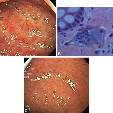 Colonic Mucosa Showing Three Schistosoma Mansoni Ova Surrounded By Download Scientific Diagram