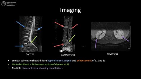 9-year-old boy presents with progressive painful swelling in right