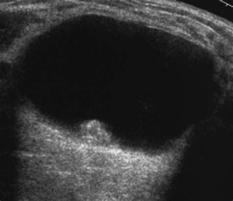 Complex Cystic Breast Masses Diagnostic Approach And Imaging