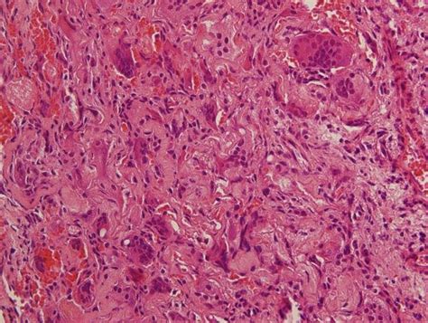 Chronic Inflammatory Cell Infiltrate Multinucleated Giant Cells And