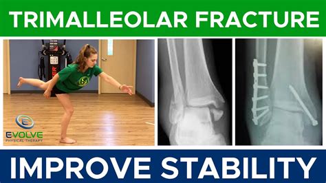 Trimalleolar Fracture Improving Dynamic Ankle Stability Part 1