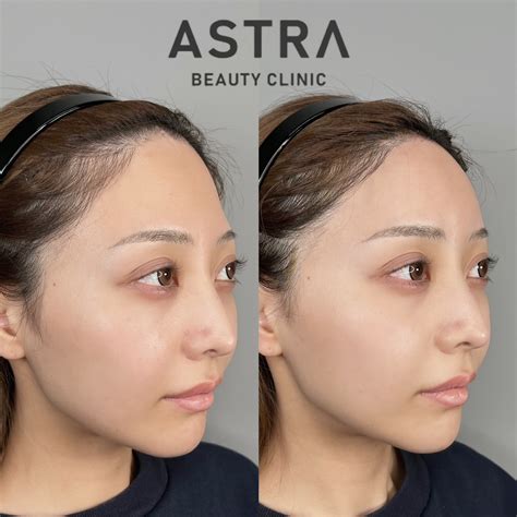 脂肪注入（額） 【公式】astra Beauty Clinic（アストラビューティクリニック）｜美容外科・美容皮膚科・形成外科｜渋谷駅前