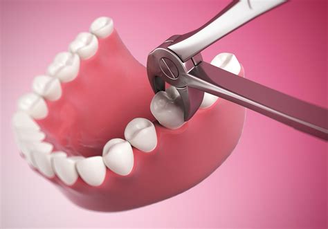 Tooth Extraction - What Is It All About? | GetDoc