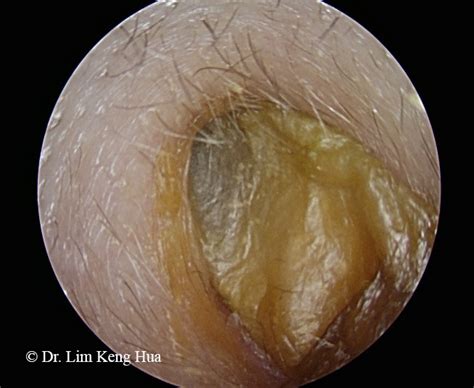 Ear Wax Dr Kh Lim Ent Clinic