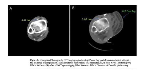 Flap monitoring with incisional negative pressure wound therapy (#NPWT ...