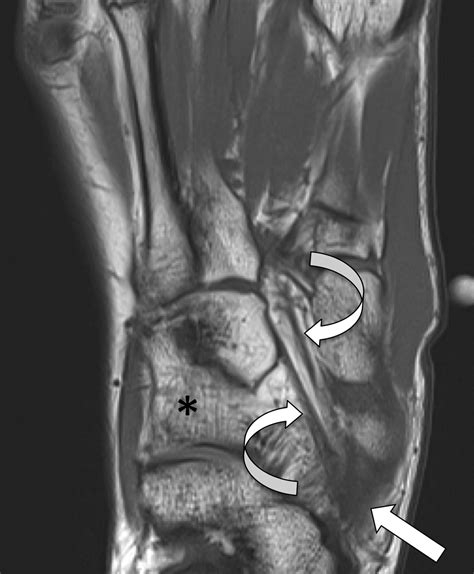 Mr Imaging Of The Midfoot Including Chopart And Lisfranc Joint