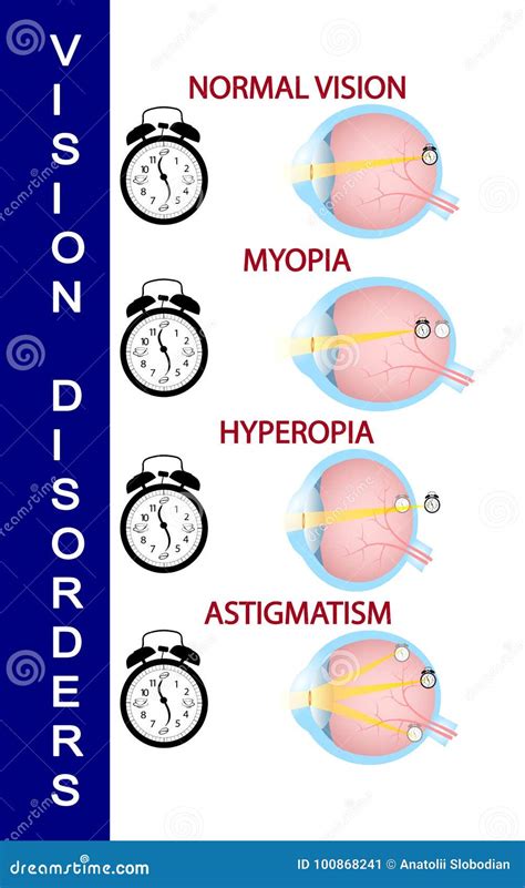 Hyperopia And Hyperopia Corrected By A Plus Lens Eye Vision Disorder