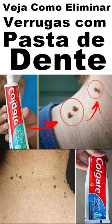 Use A Pasta De Dente Desta Maneira Para Remover Verrugas Toothpaste