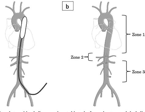 Figure From Successful Management Of Resuscitative Endovascular