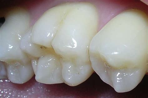 Discover 5 Benefits Of Early Tooth Decay Treatment Today