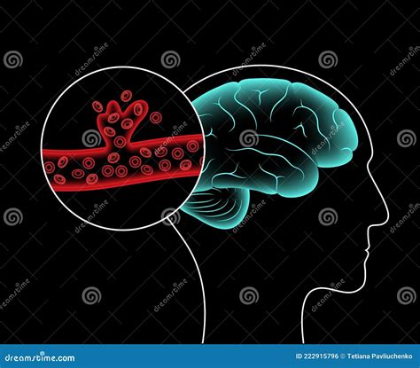 Brain Stroke Hemorrhagic Stock Vector Illustration Of Test 222915796