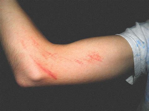 Keratosis Pilaris Keratosis Pilaris Symptoms Causes And More