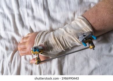 External Fixator Wrist Fracture Stock Photo 1986990443 | Shutterstock